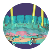 Coronas o puentes sobre implantes